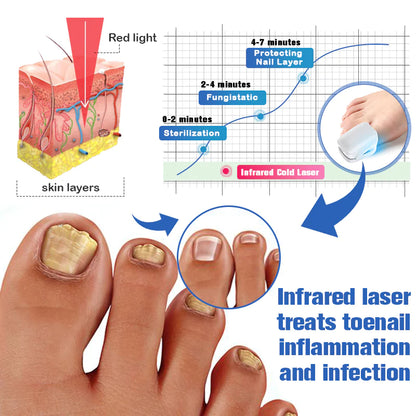 Furzero Nail Fungus Laser Therapy Device - Hot Sale 50% Off