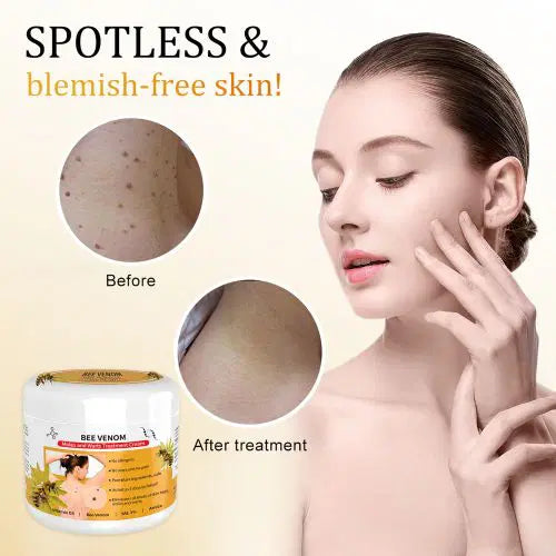 Bee Venom Mole and Wart Treatment Cream – Hot sale 50%