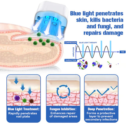 Furzero Nail Fungus Laser Therapy Device - Hot Sale 50% Off