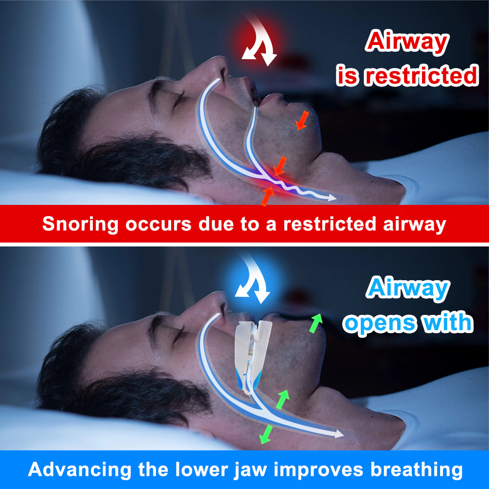 Adjustable Anti-Snoring Mouthpiece