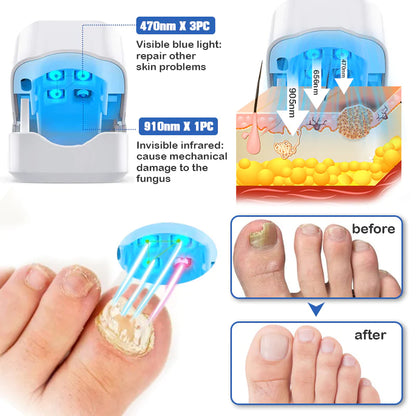 Furzero Nail Fungus Laser Therapy Device - Hot Sale 50% Off