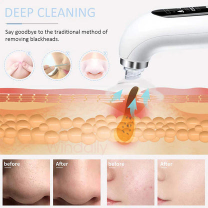 Claxten Blackhead Water Vacuum - Hot Sale 50%